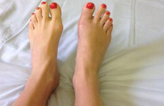 早上起来脚心疼怎么办?